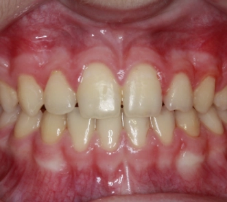 Überstellen des Kreuzbisses mittels loser Spange in Kieferorthopädischer Fachpraxis Prof. Jilek in Wolfratshausen