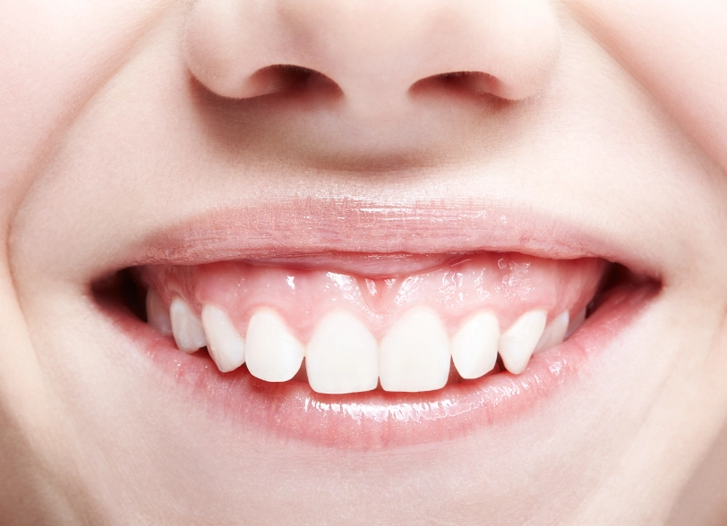 Gummy Smile