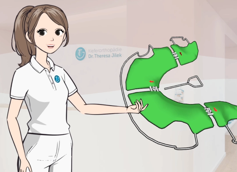 Die herausnehmbare Zahnspange