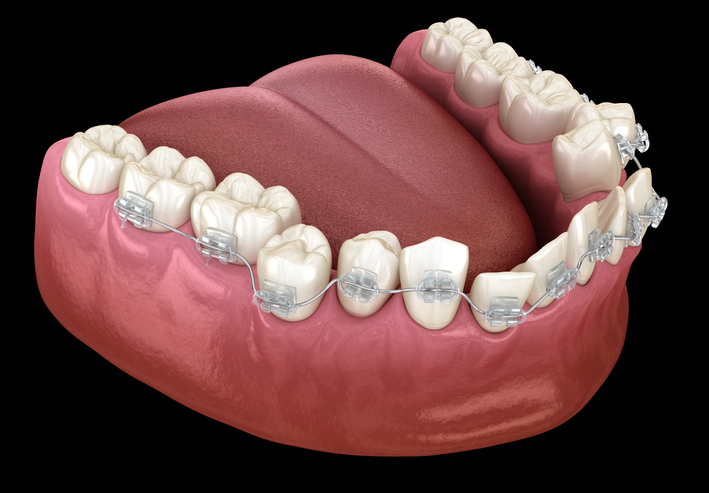 schiefe Zähne, die mit Brackets und einem Bogen gerade gestellt werden